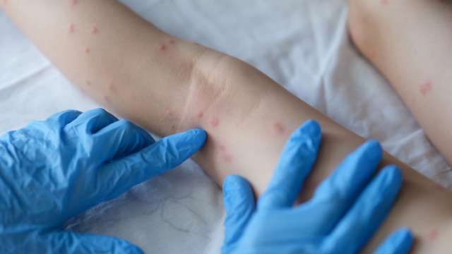 Драстичен ръст на случаите на варицела отчитат здравните власти в