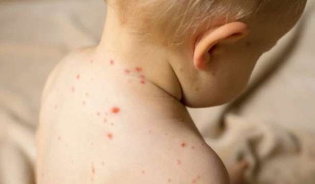 Дете на годинка и четири месеца без имунизация за морбили