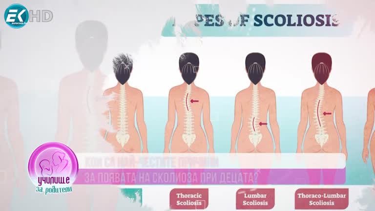Петър Петров за сколиозата при деца